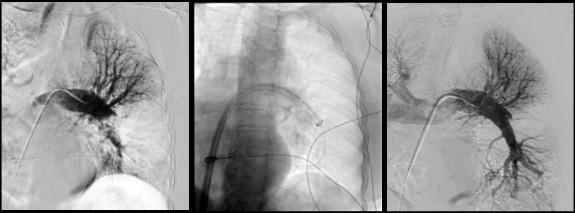 three black and white c t scan images of pulmonary artery thrombectomy