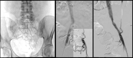 Three black and white C T scans of a thrombectomy procedure