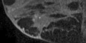 Breast MRI before intravenous contrast