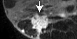 Breast MRI image after intravenous contrast